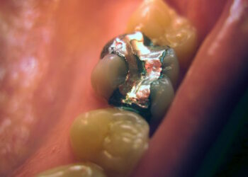 Ecologistas en Acción pide a los europarlamentarios que eliminen el mercurio dental