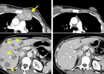 Eliminan el cáncer de mama gracias a las células T de la propia paciente