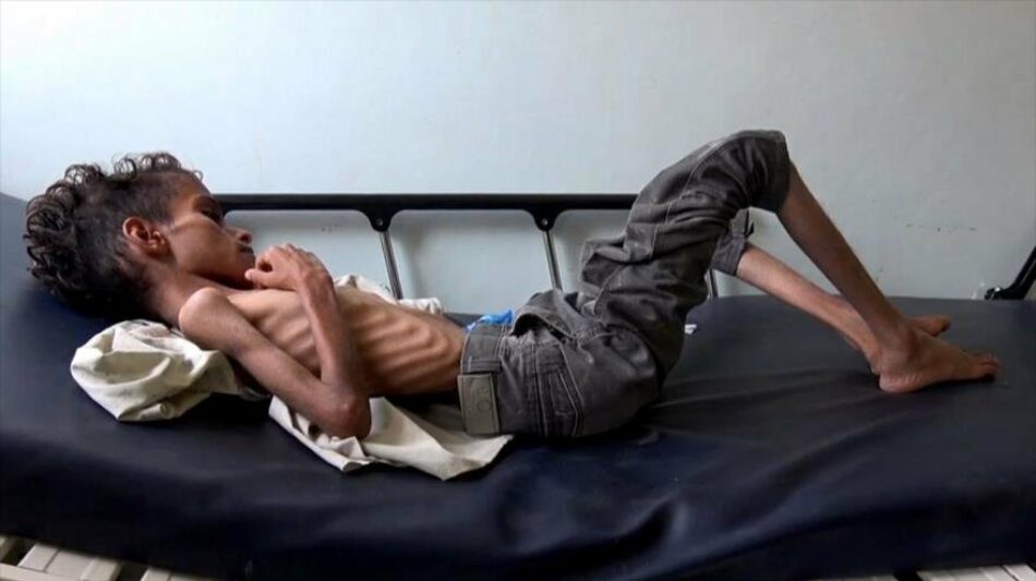 85 000 niños han muerto de hambre en Yemen desde la agresión saudí