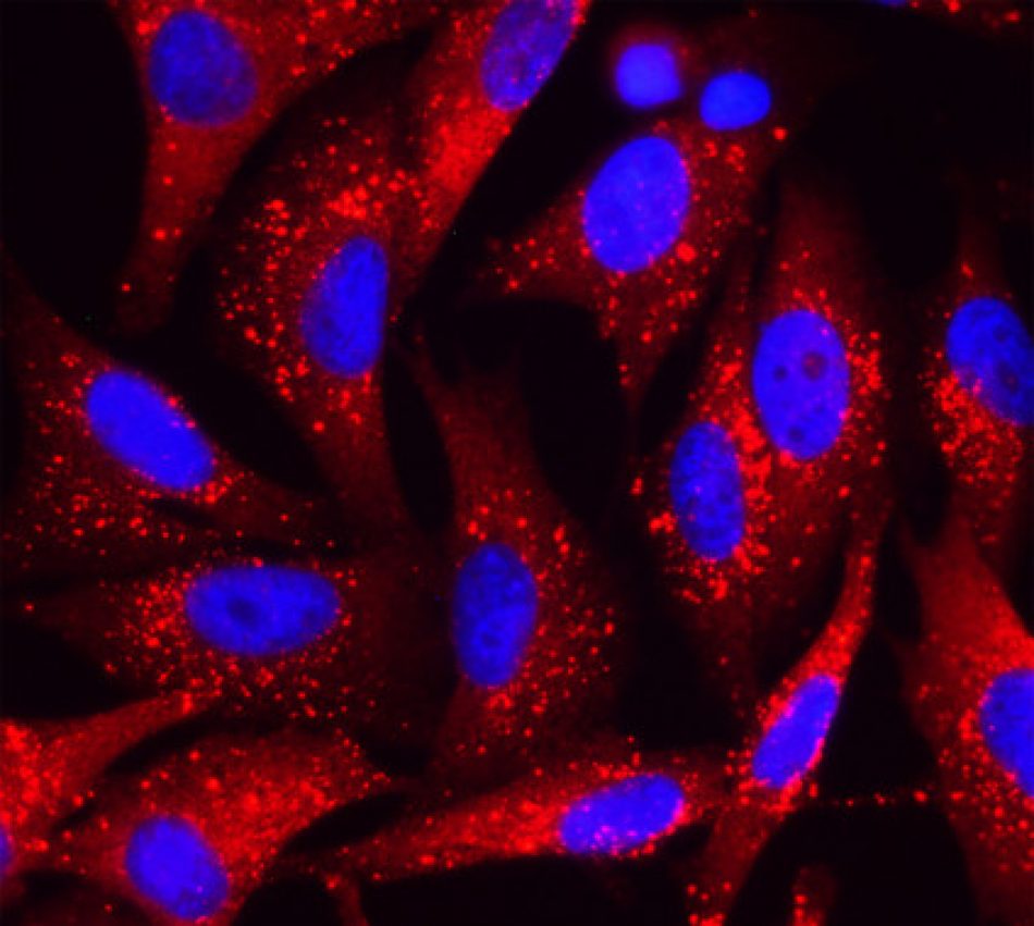 Dos proteínas comienzan a desvelar el ‘caos’ del melanoma