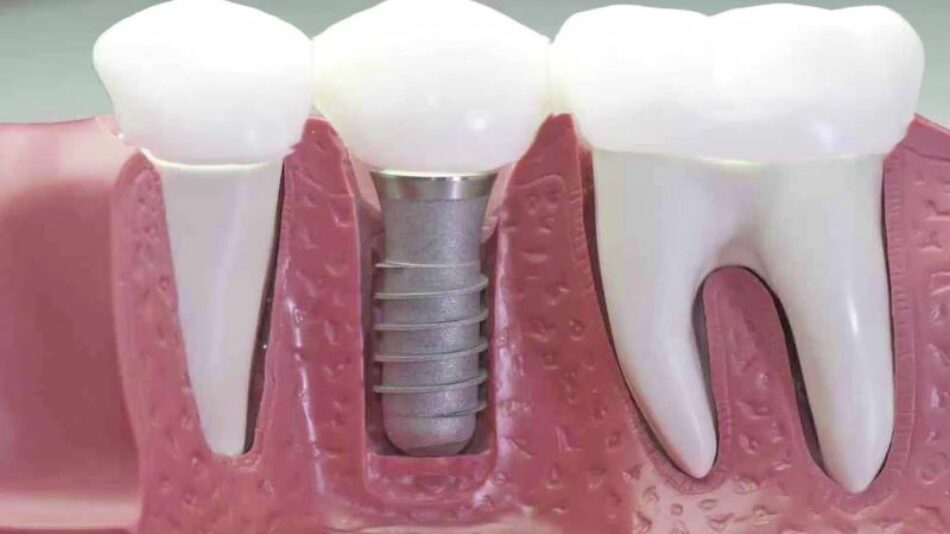 Implantes dentales
