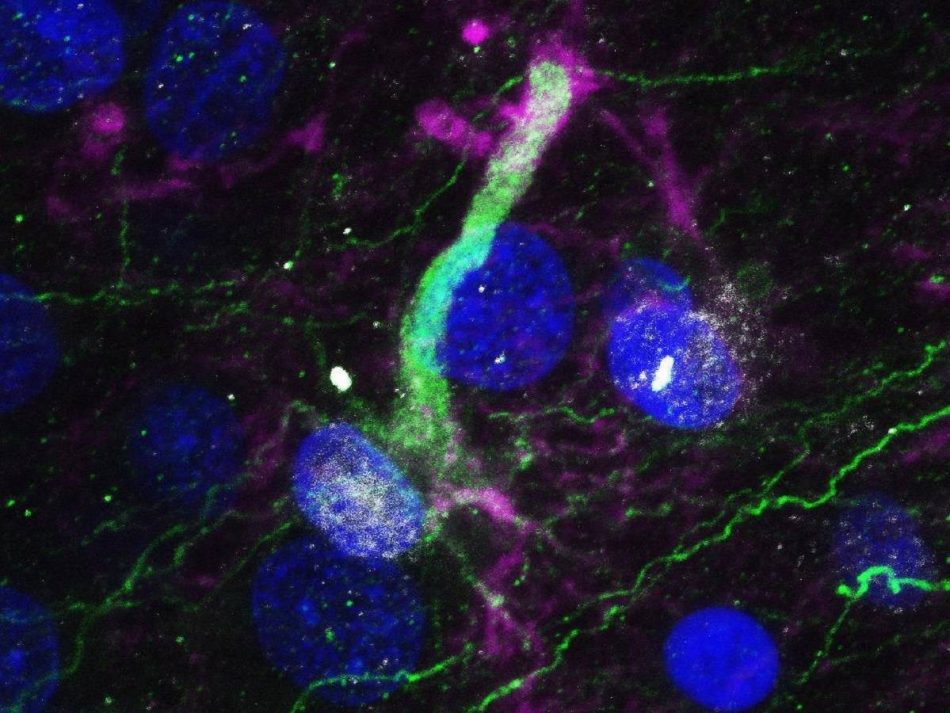 Demuestran que las enfermedades neurodegenerativas atacan a las células madre del cerebro y les impiden generar neuronas sanas