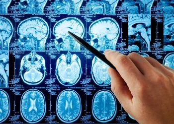 La inteligencia artificial revela variaciones en la anatomía cerebral de personas con autismo