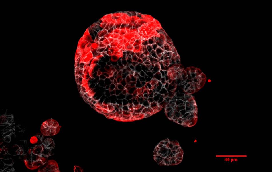 Descubiertas las células responsables de las recaídas en el cáncer de colon