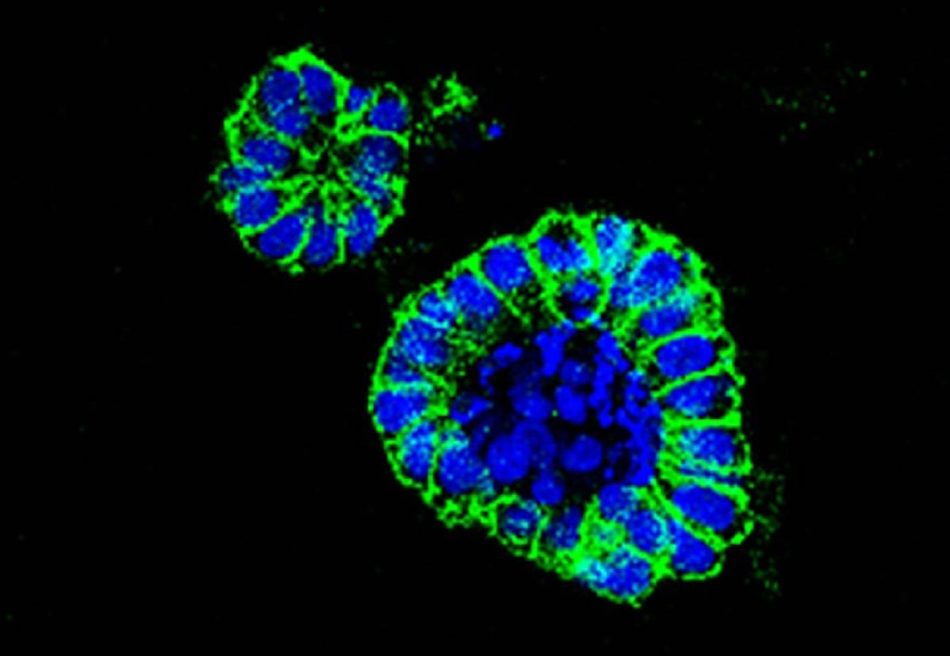 Un nuevo fármaco frente a un transportador de aminoácidos es efectivo en cáncer de colon