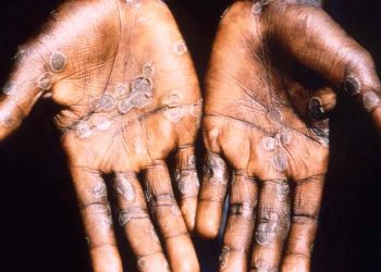 La OMS preocupada por variante de Mpox extendida por RDC