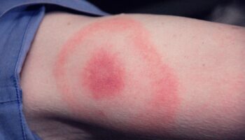 Garrapatas y enfermedad de Lyme, una plaga creciente en España