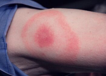 Garrapatas y enfermedad de Lyme, una plaga creciente en España