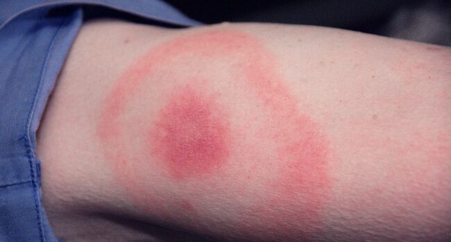 Garrapatas y enfermedad de Lyme, una plaga creciente en España