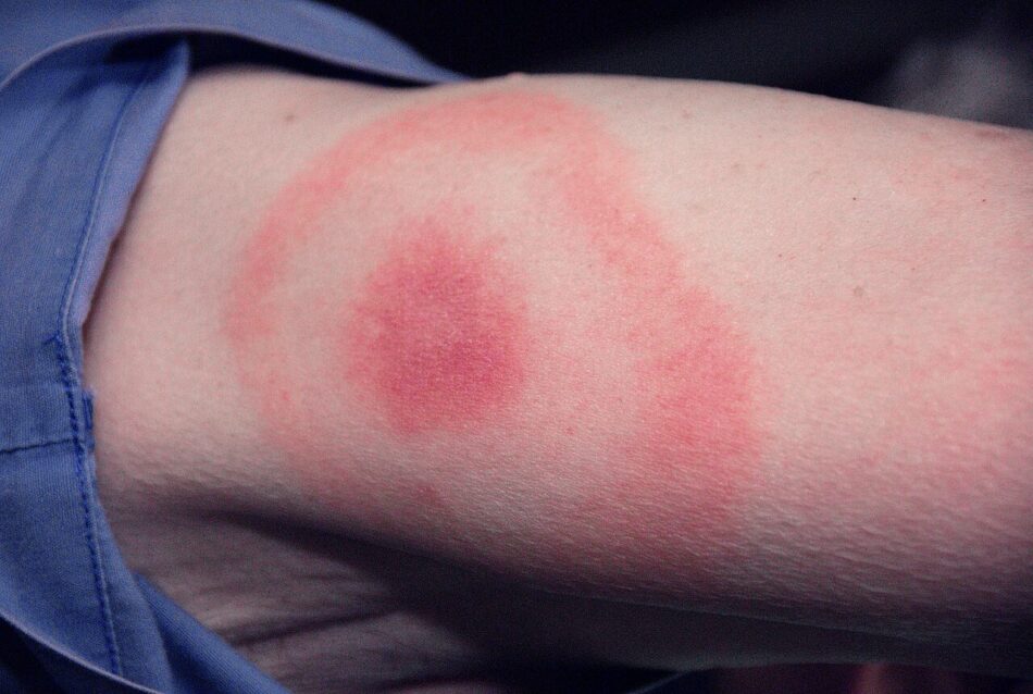 Garrapatas y enfermedad de Lyme, una plaga creciente en España