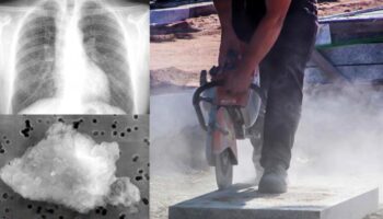 España sufre una reemergencia de la silicosis en el siglo XXI