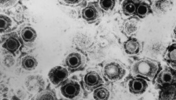 Descubren un antiviral contra el herpes que vence la resistencia a las curas actuales