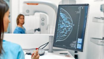 Una densidad mamográfica alta podría estar asociada con tumores de peor pronóstico