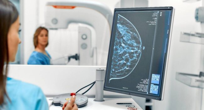 Una densidad mamográfica alta podría estar asociada con tumores de peor pronóstico