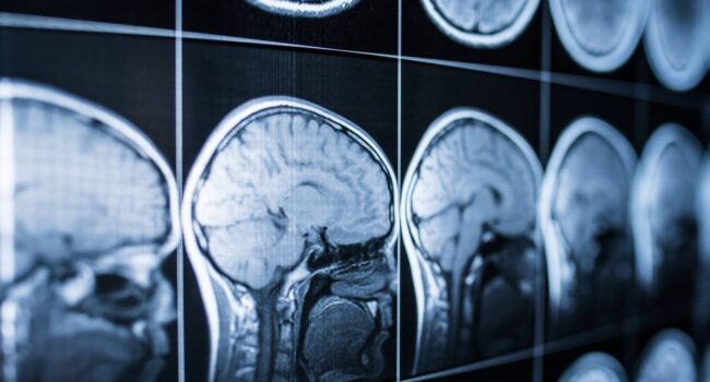 ¿Cómo afecta un ictus a la comprensión del habla? Nuevas claves desde el cerebro