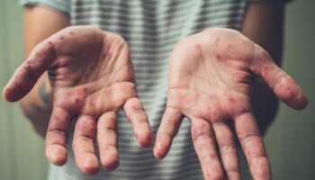 ¿Qué significa que la OMS haya anunciado que España pierde el estatus de país libre de sarampión?