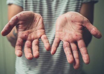 ¿Qué significa que la OMS haya anunciado que España pierde el estatus de país libre de sarampión?