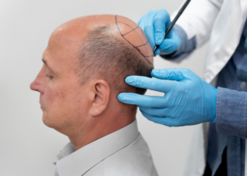 Alopecia areata: causas y factores que influyen