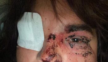 La Plataforma Trans condena la brutal agresión de una mujer trans en la que casi pierde un ojo