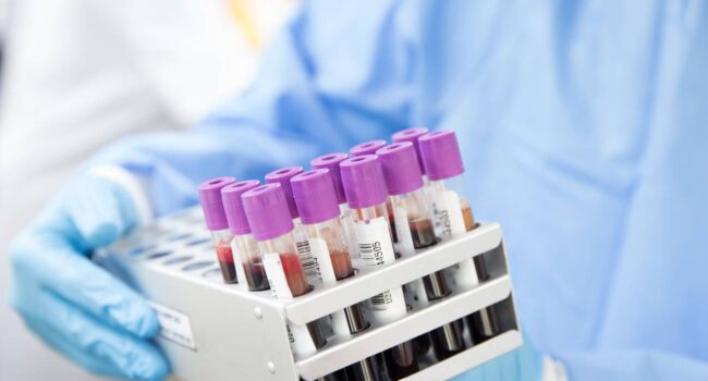 Primer caso de ‘curación’ del VIH con un trasplante de células madre procedente de un hermano