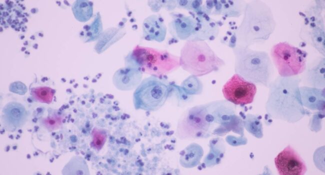 Desarrollan un sistema de IA para detectar una de las infecciones sexuales más frecuentes del mundo
